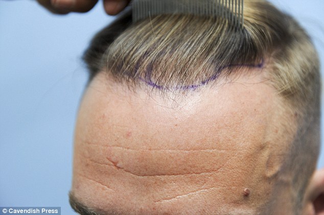 how to regrow lost hairs
